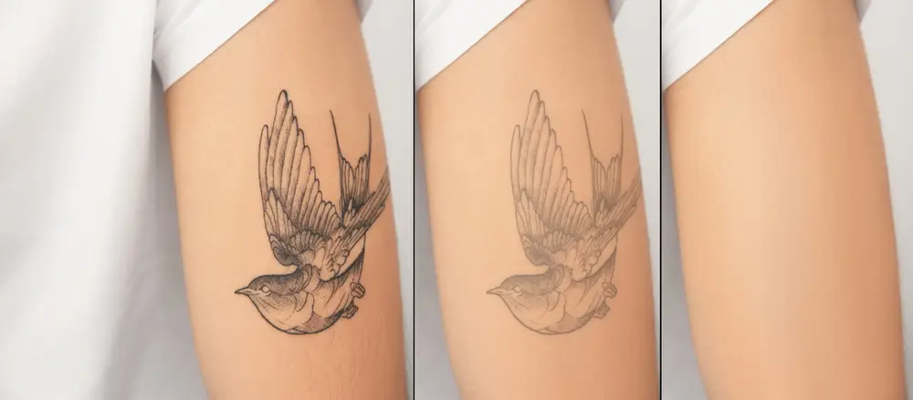 Rimuovi Tatuaggio