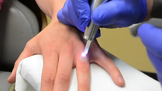 Come Rimuovere un Tatuaggio dalle Dita: Procedure, Costi e Consigli Utili